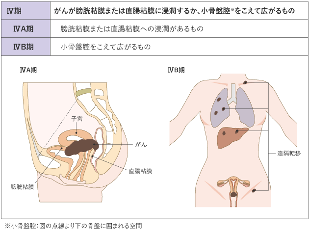 表1 子宮頸がんの臨床進行期分類(日産婦2020、FIGO 2018) Ⅳ期
